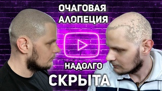 Кейс: очаговая алопеция надолго скрыта. Трихопигментация мастер Афанасьев. Scalp Micropigmentation.