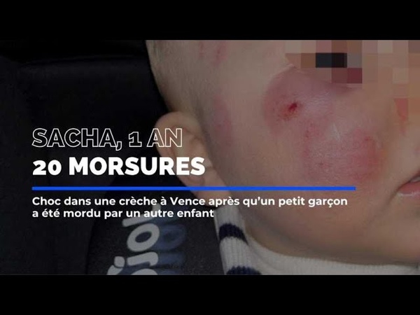 Choc à Vence : un enfant marqué par des morsures choquantes dans une