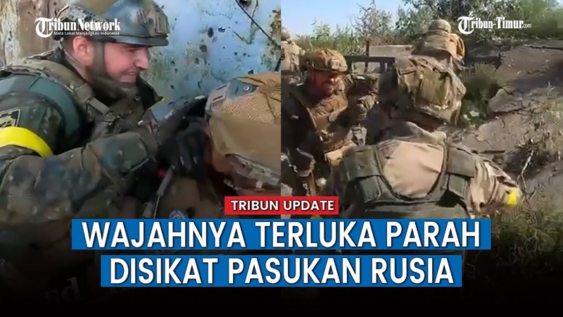 Aksi Tentara Ukraina yang Alami Luka Parah pada Bagian Wajah Buat Warganet Geleng