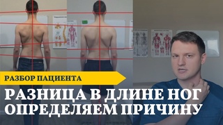 Сколиоз - где причина | Челюсть или стопы