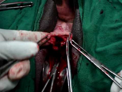 TVT. O for SUI, Trans obturator sling, Bladder