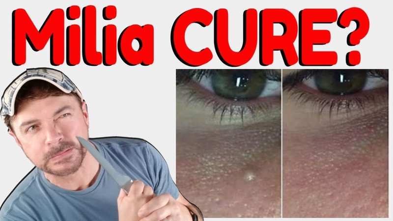 How To Get Rid Of Milia, Hard White Bumps on Face and Eyes, Chris