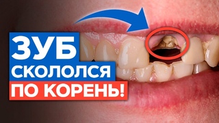 Что делать, если зуб скололся / Откололся зуб - варианты лечения