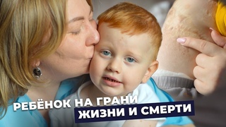 НЕВУС С УЗЛАМИ ГИБРИДНОЙ ОПУХОЛИ | История Максима Мирзоева