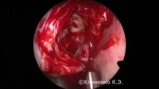 Расширенная эндоскопическая фронтотомия при сложной анатомии. Extended frontal sinusotomy.