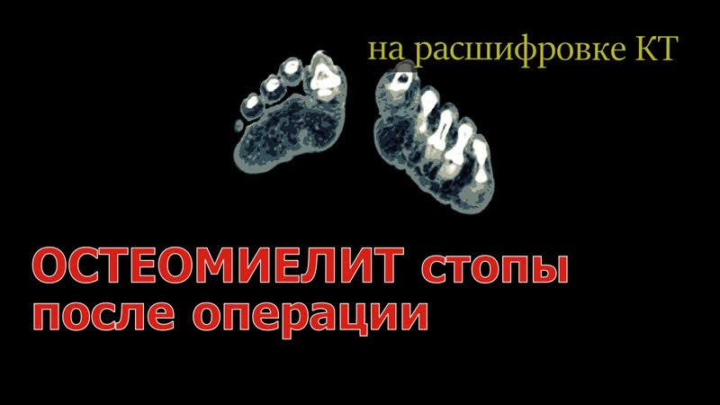 ОСТЕОМИЕЛИТ СТОПЫ после операции hallux valgus. Остеомиелит