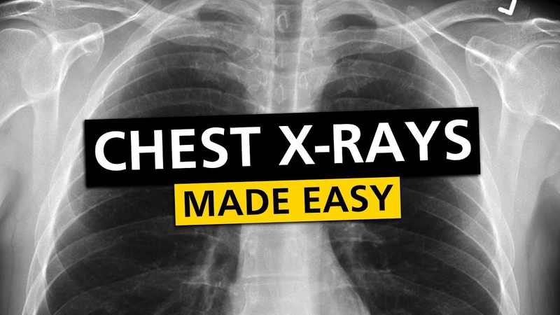 Chest X Rays ( CXR) Made Easy Learn in 10