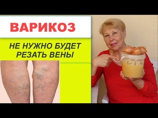Варикоз-лечение Поделилась рецептом одна бабушка И резать вены не стоит