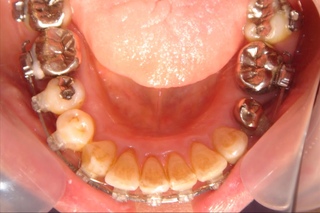 Orthodontic library ID. Dental crowding  Chart