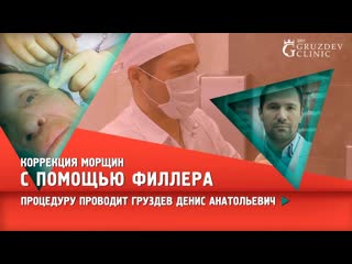 Устранение морщин с помощью филлера.