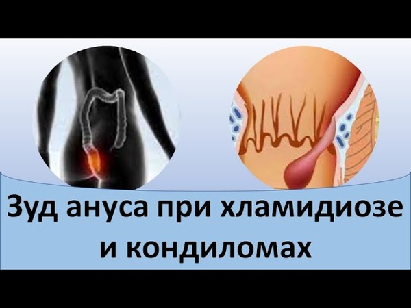 Зуд ануса при хламидиозе и