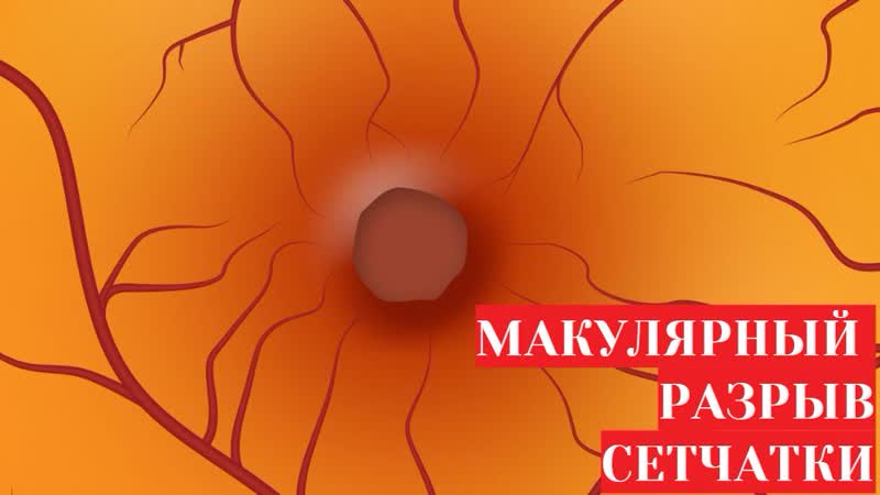 Макулярный разрыв сетчатки причины, лечение, поведение